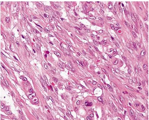 Figure 5 Undifferentiated carcinoma is an epithelial neoplasm with a significant component showing no glandular structures  or other features to indicate a definite direction of differentiation (Hruban &amp; Fukushima 2007)