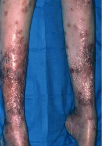 Figure 4: Érythème migrateur nécrolytique situé sur les jambes d'un patient atteint du 