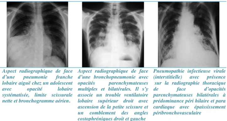 Figure 5  : aspects radiographiques des PAC[82] 