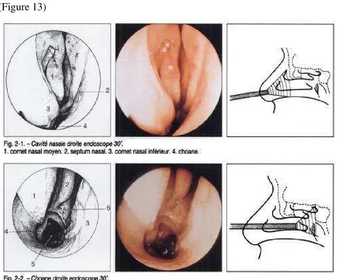 Figure 13: Montrant la cavité nasale droite et choane droite sous endoscope  30° 