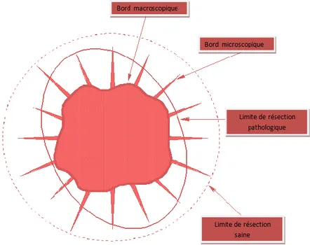 Figure n° 21 : schéma illustrant la configuration spatiale d’une tumeur intracrânienne, notez  que l’envahissement tumoral dépasse la limite macroscopique de la lésion