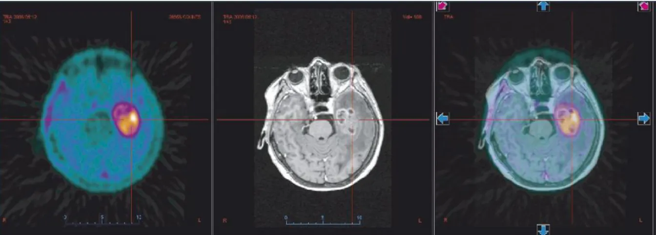 Figure n° 28 : TEP FET et IRM réalisées avant biopsie : diagnostic de glioblastome. 