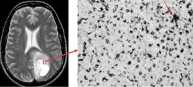 Figure n° 35 : Résultat anatomo-pathologique d’une biopsie stéréotaxique :   image en microscopie optique (x200) montrant cellularité modérée, sans mitoses ni 