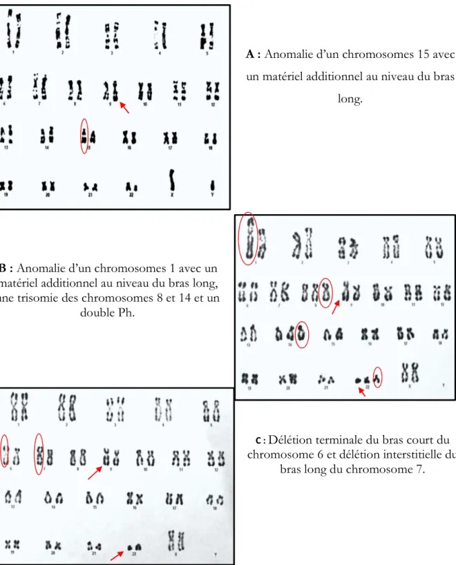Figure 17: Caryogrammes montrant des anomalies cytogénétiques additionnels au  chromosome Ph chez des patients LMC au moment du diagnostic 