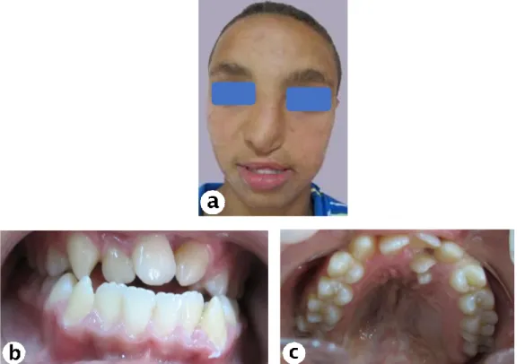 Figure 6 : F.A, 14ans, fente labio-palatine unilatérale, dent surnuméraire évoluée en palatin (c)  Vue de face (a), vue endobuccale (b,c)