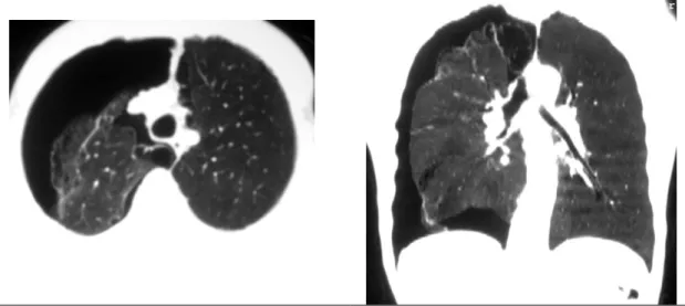 Fig. 16 – Patient de 51 ans, tabagique à 32 PA. TDM thoracique pour 