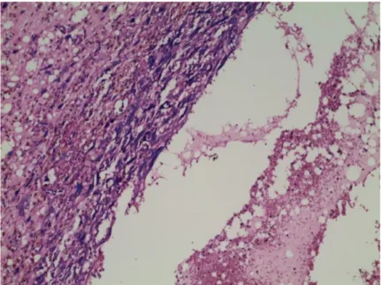 Figure 19 (Gx10):Aspect kiystique d’un pleuropneumoblastome 