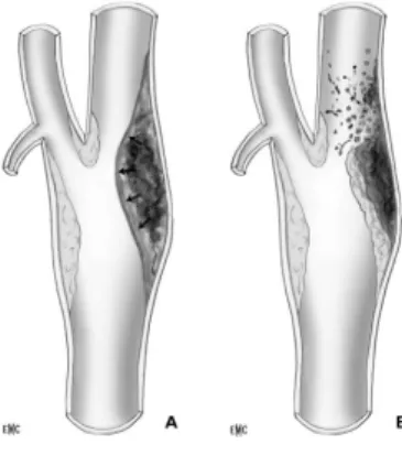 Figure 3: complications anatomiques au niveau de la plaque: 28  A-hémorragie B-ulcération 
