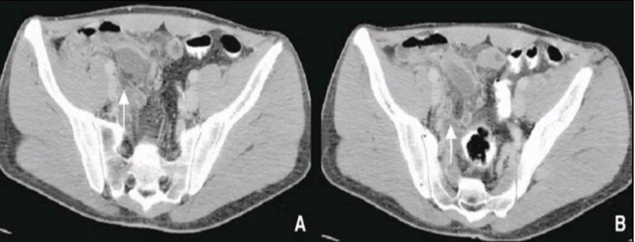 Fig. 5 : Appendicite compliquée d'une collection périappendiculaire. 