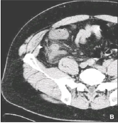 Fig. 7 : Infiltration de la graisse en arrière du cæcum, en regard de l'appendice enflammé  (flèche)