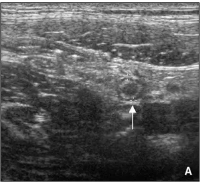 Fig. 8 : Appendice normal : échographie montrant une structure digestive boudinée  (flèche) dont le diamètre transverse est inférieur à 6 mm