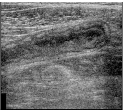 Fig. 11 : Échographie d'une atteinte inflammatoire de l'appendice : boudin digestif  élargi, avec  paroi épaissie et interruption focale de la sous 
