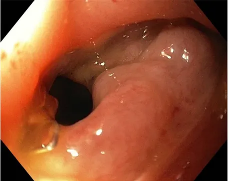 Figure 6 Fermeture des 2 fistules par mise en place de 9 clips 