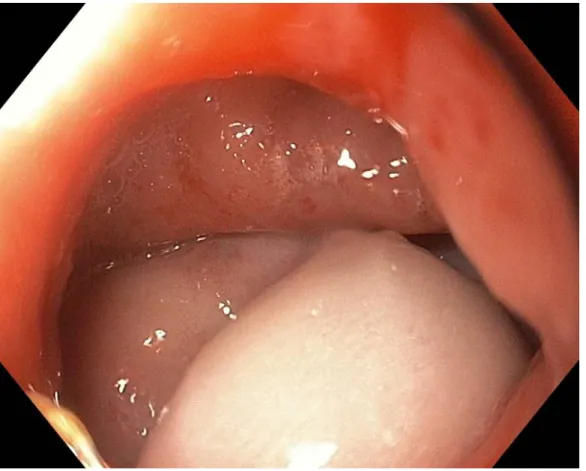 Figure 11 Fistule recto-vaginale de 2 cm 