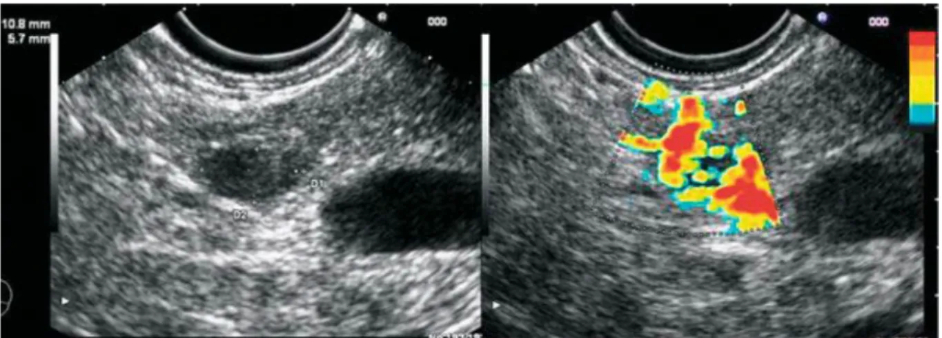 Figure 3 :Sonovue® : aspect de tumeur endocrine du pancréas :  Hyper vascularisation (à gauche) [8] 