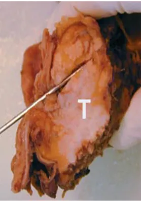 Figure 8-b : ADK pancréas: vue  microscopique d'un    engainement péri 