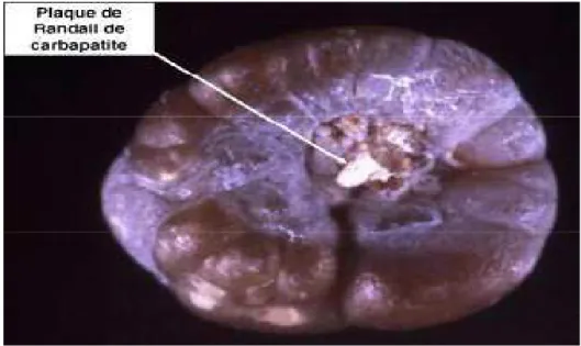 Figure 2: Calcul de whewellite formé sur la papille rénale à partir d’une plaque de Randall [19]