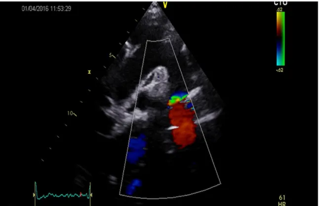 Figure 19B: Vue supra-sternale chez la même patiente, avec au niveau de la striction isthmique,  un aliasing au doppler couleur