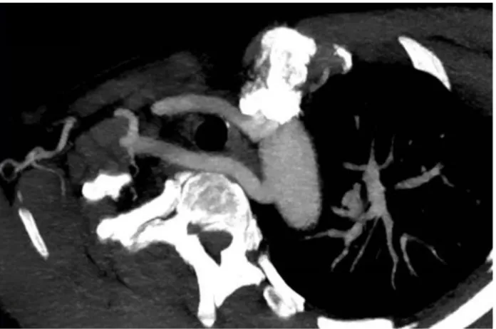 Figure 13 : Angioscanner thoracique après reformatage MIP dans l’axe de l’artère sous-clavière  montrant une artère sous-clavière droite retro-œsophagienne