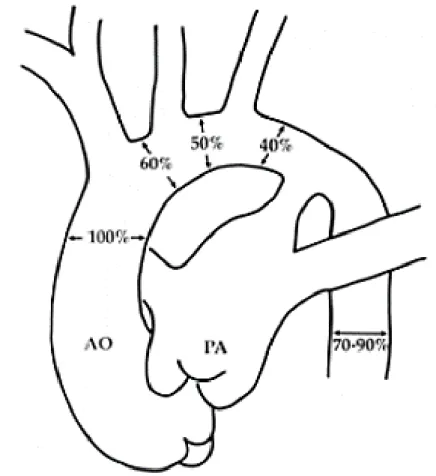 Figure 15 : Diamètres relatifs minimaux de l'aorte thoracique normale chez le nouveau-né et le  nourrisson