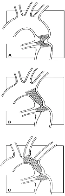 Figure 10:  Classification chirurgicale de la coarctation selon Amato. 44 A- Type I       B- Type II       C- Type III 