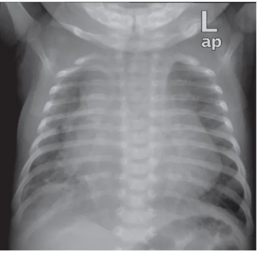 Figure 14 : Radiographie thoracique de face montrant une cardiomégalie avec œdème  pulmonaire chez un nouveau-né