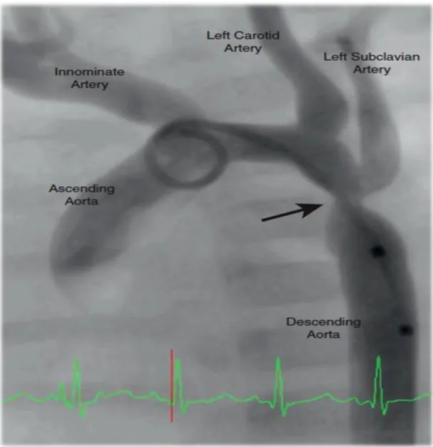 Figure 12: Angiographie objectivant une coarctation de l’aorte modérée siégeant en aval de  l’artère sous-clavière gauche