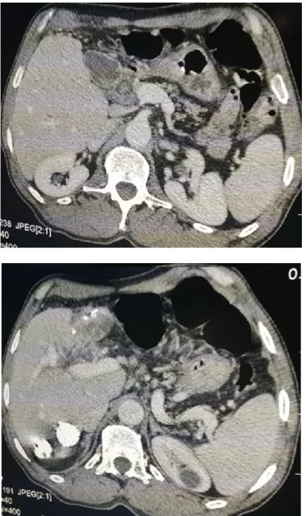 Figure 21: Angiocholite aiguë lithiasique 