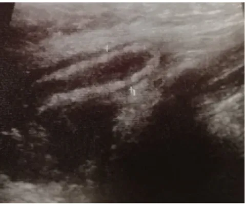 Figure 13:  Echographie en faveur d’ Appendicite aiguë non compliquée 