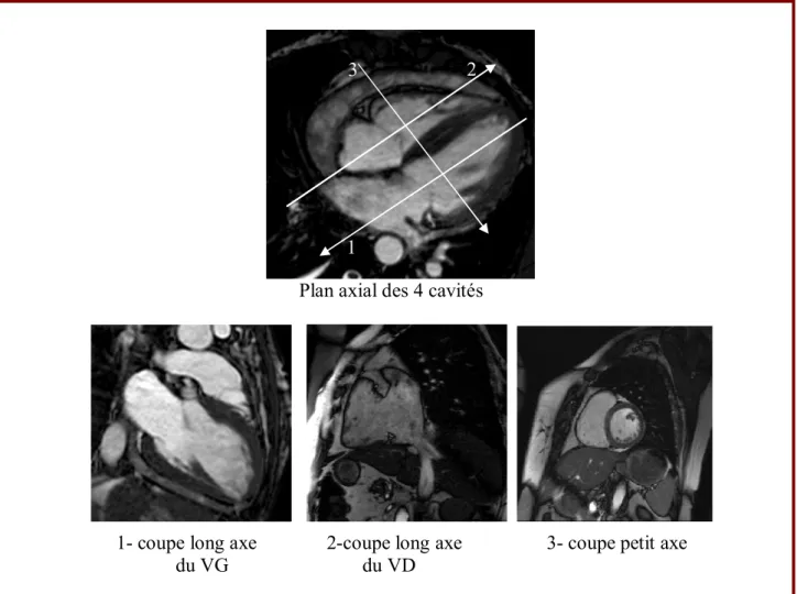 Figure 2 : les différents plans de coupe à l’IRM cardiaque. 