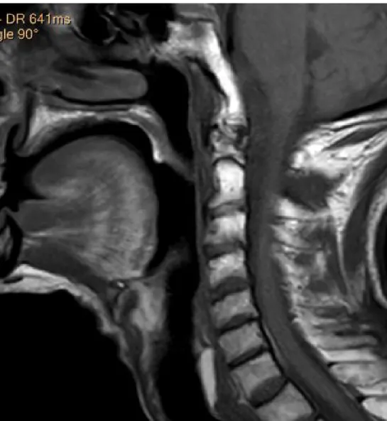 Figure 2  : IRM cervicale en coupe sagittale SP T1 montrant les parois du cavum 