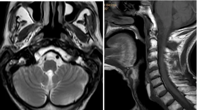 Figure 3 : IRM cervicale en coupe axiale, SP T2 et coupe sagittale   en SP T1montrant les différents rapports du cavum 