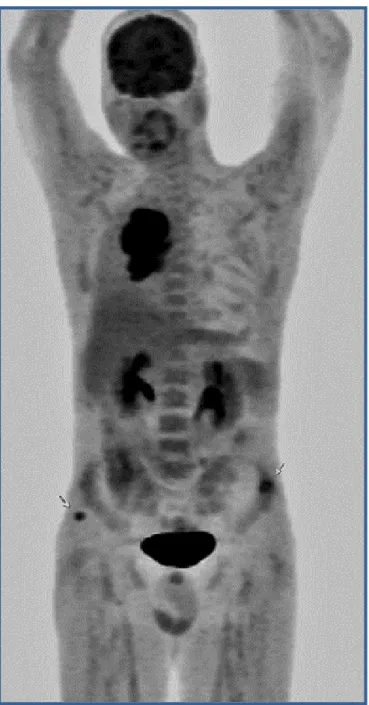Figure 24: PET-FDG corps entier : image MIP montrant un hypermétabolisme pathologique  d’allure tumorale en trois sites anatomiques : la tumeur pulmonaire droite et ses métastases au 