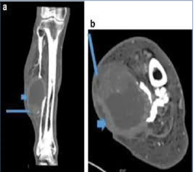 Figure 22: Images du scanner  en coupe axiale et transversale d’un abcès de la jambe[71]  