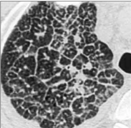 Fig. 13 - Coupe scannographique d’une lymphangite pulmonaire mettant parfaitement  en évidence l’épaississement des cloisons périlobulaires (ici syndrome interstitiel)