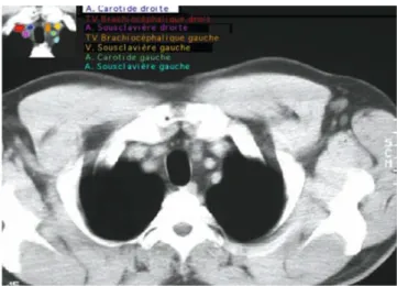 Fig. 19 - TDM : coupe anatomique du médiastin supérieur, coupeau niveau des  vaisseaux cervicaux