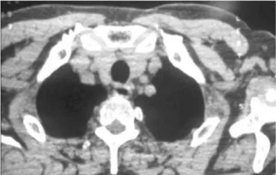 Fig. 20 - TDM : coupe anatomique du médiastin supérieur, visualisation des lobes de la  thyroïde