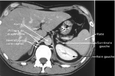 Fig. 24 - TDM : coupe anatomique au niveau du médiastin inférieur et des piliers du  diaphragme