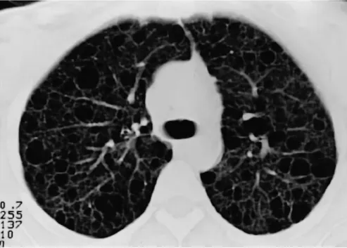 Figure 28 : Lymphangiomyomatose pulmonaire. L’atteinte parenchymateuse est  caractérisée par la présence de multiples kystes qui mesurent entre quelques millimètres 