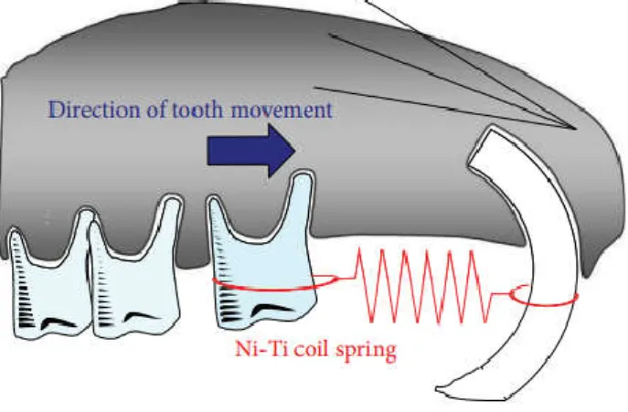 Figure 1 : Schéma du mouvement des dents avec un appareil orthodontique chez la souris