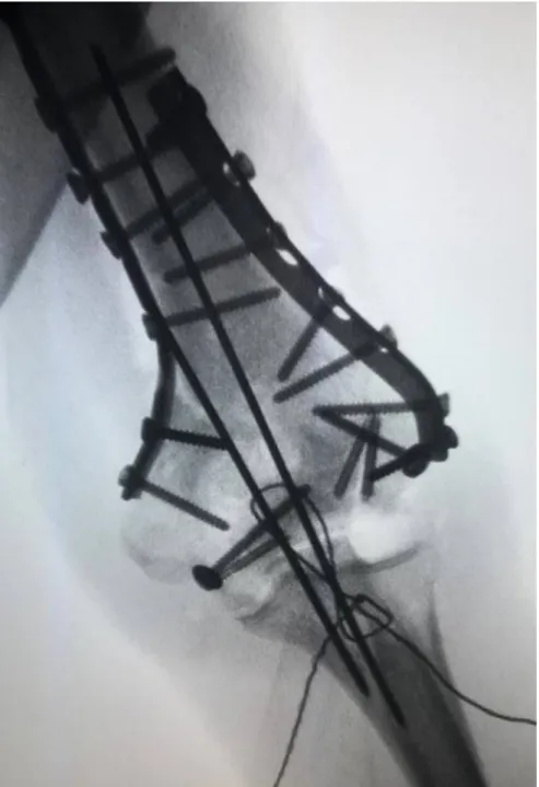 Figure 9: Image montrant un contrôle de la stabilité de la fracture en peropératoire par  fluoroscopie