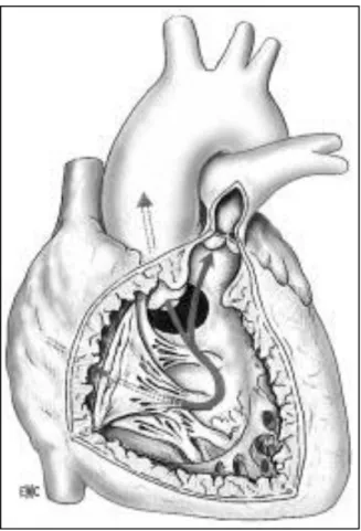 Fig. 2 : Schéma des composants principaux de la tétralogie de Fallot. [19] 