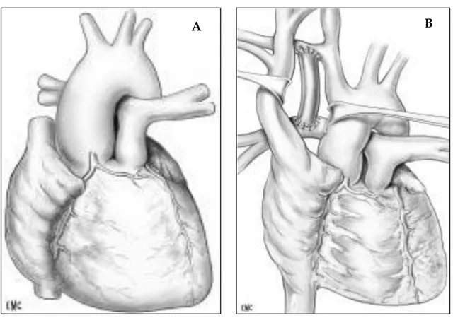 Fig. 4  Artère infundibulaire très haute. 