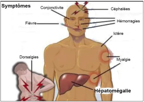 Figure 3 : Résumé des symptômes de la fièvre jaune 