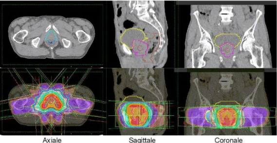 Figure 7. En haut : Illustration des principales structures d’intérêt (prostate, rectum, vessie)  sur trois coupes de l’image TDM d’un patient