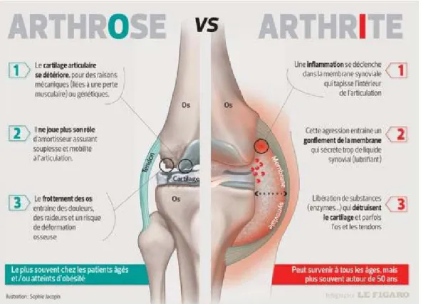 Figure 2: Différenciations entre l’arthrose et l’arthrite [17] 