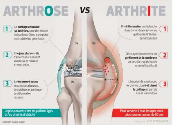 Figure 2: Différenciations entre l’arthrose et l’arthrite [17] 