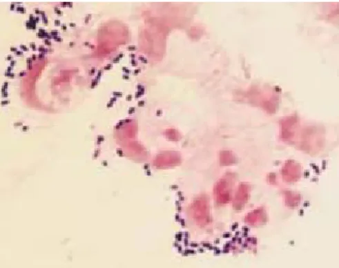 Figure 4: Vue au microscope après coloration de gram du pneumocoque [24] 