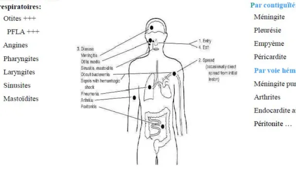 Figure 9: Pouvoir pathogène du pneumocoque [25] 