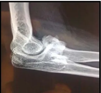 Figure 2 : Radiographie montrant des butoirs osseux à localisation antérieure 